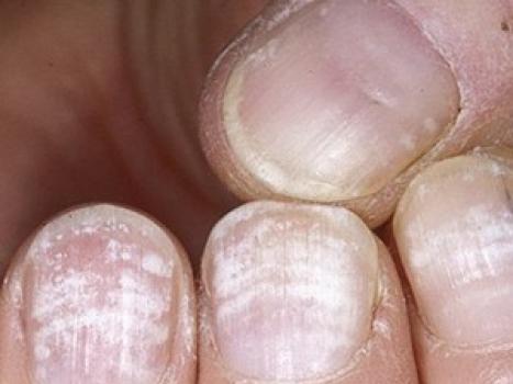 Онихолизис ногтей лечение препараты недорогие но эффективные